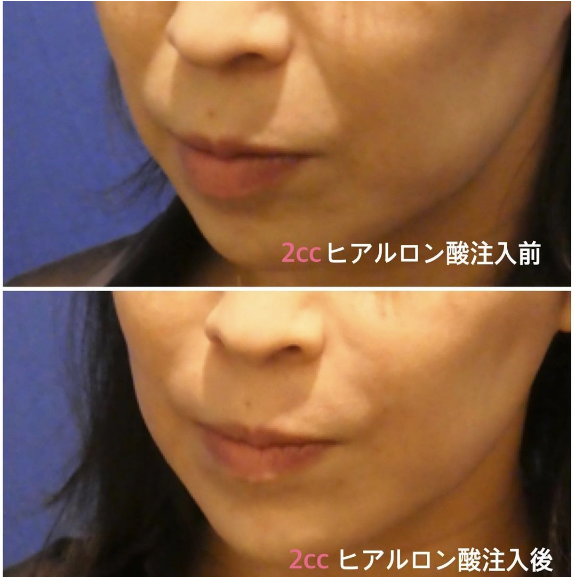ほうれい線治療 おすすめ