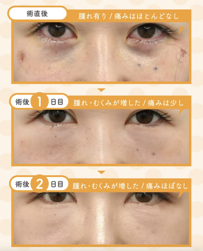 湘南美容クリニック　クマ取り
