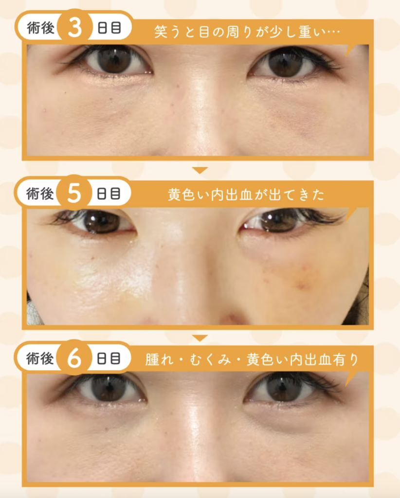 湘南美容クリニック　クマ取り