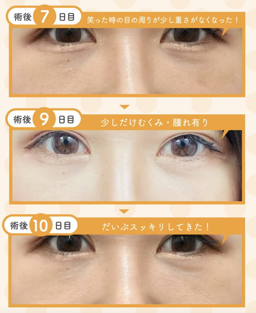 湘南美容クリニック　クマ取り