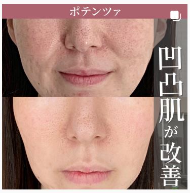 ポテンツァ　やめたほうがいい