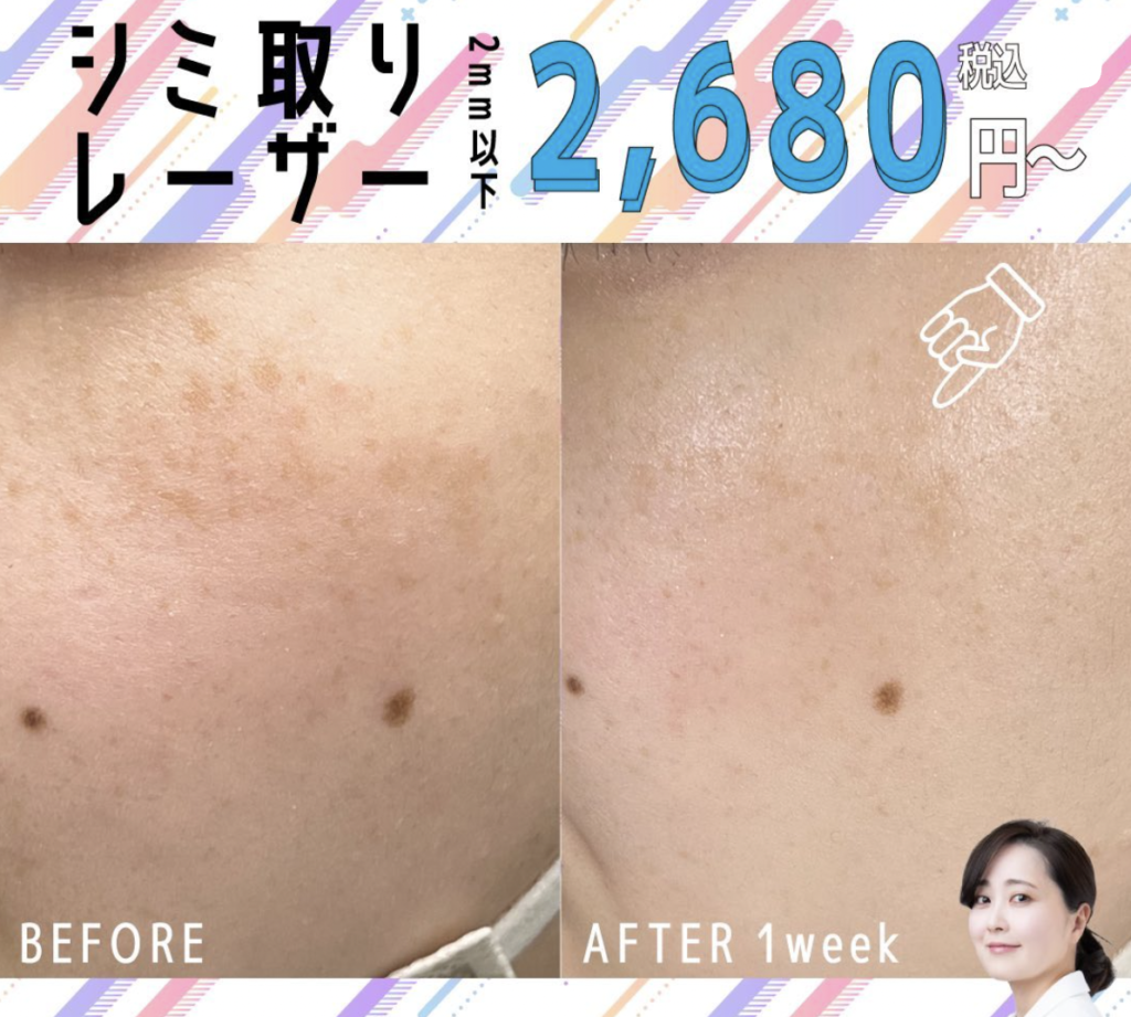 湘南美容クリニック 富山院 シミ取り放題