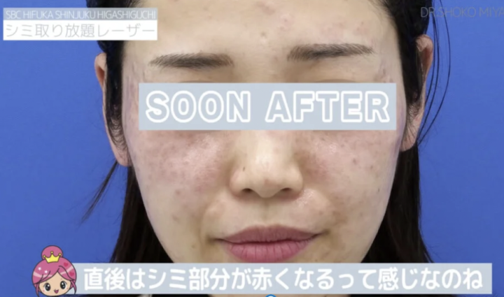 湘南美容クリニック 秋田院 シミ取り放題