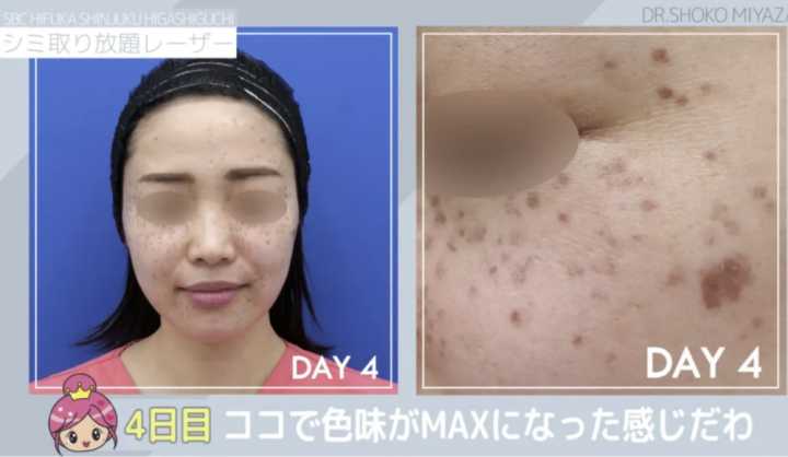 湘南美容クリニック 秋田院 シミ取り放題