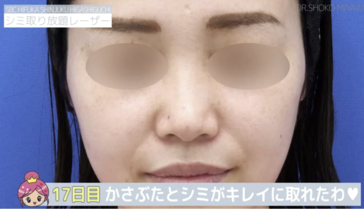 湘南美容クリニック 秋田院 シミ取り放題
