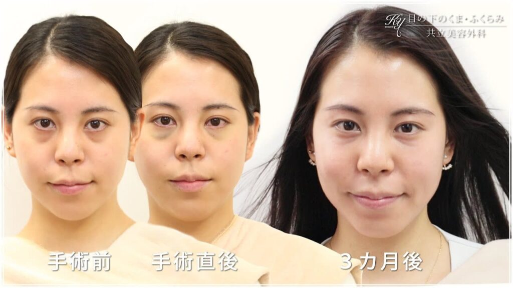 共立美容外科 目の下のクマ取り