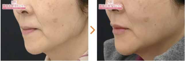 湘南美容クリニック ヒアルロン酸