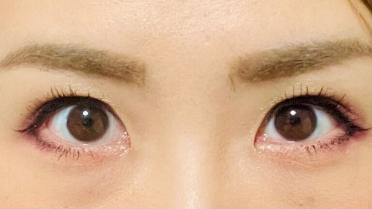 瞼（まぶた）の脂肪取りは意味ない？施術方法や施術のメリット・デメリットを解説