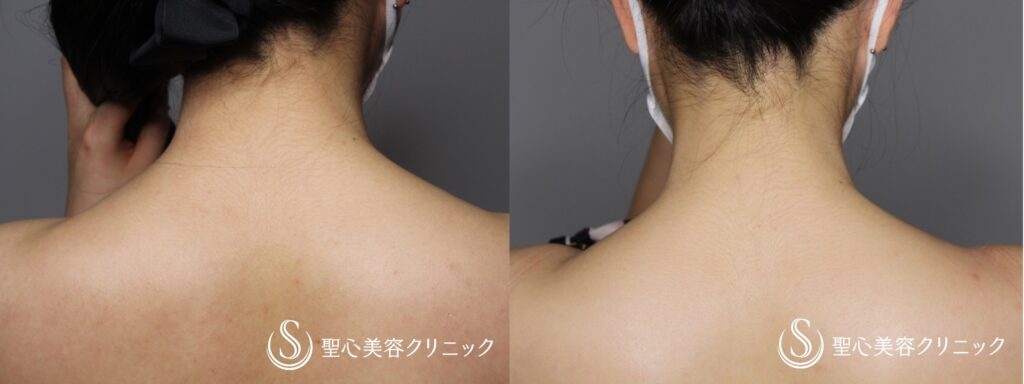 聖心美容クリニック 肩ボトックス
