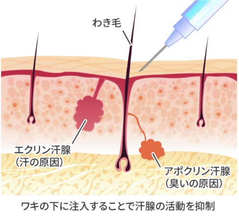 東京美容外科 脇汗ボトックス