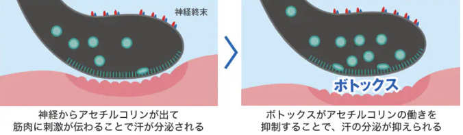 湘南美容クリニック 脇ボトックス メカニズム