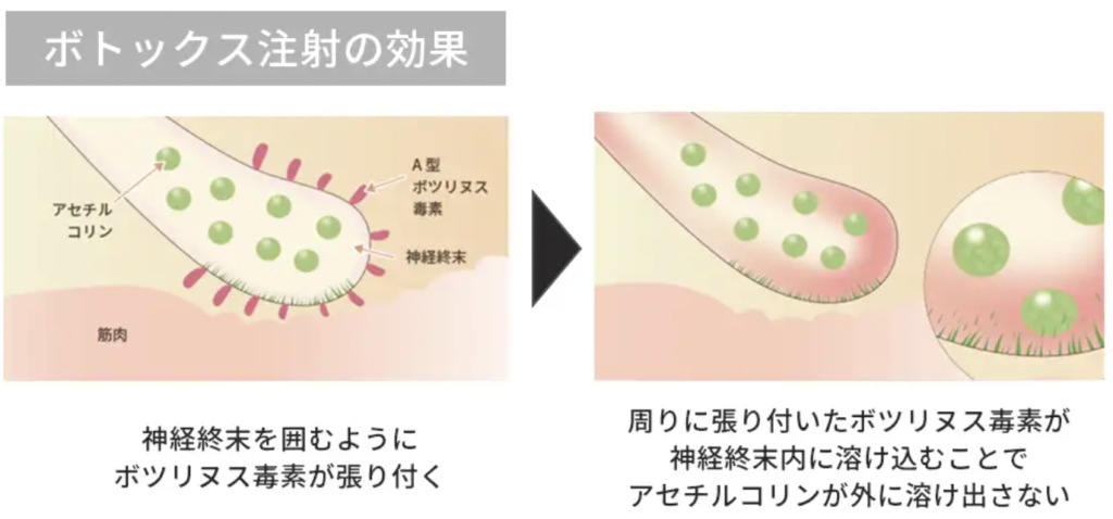 脇汗ボトックス注射 福岡