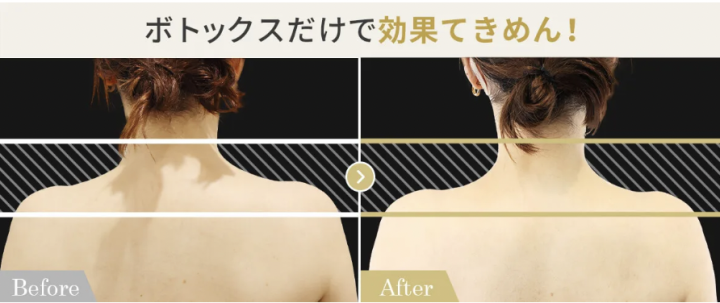 TAクリニック　肩ボトックス