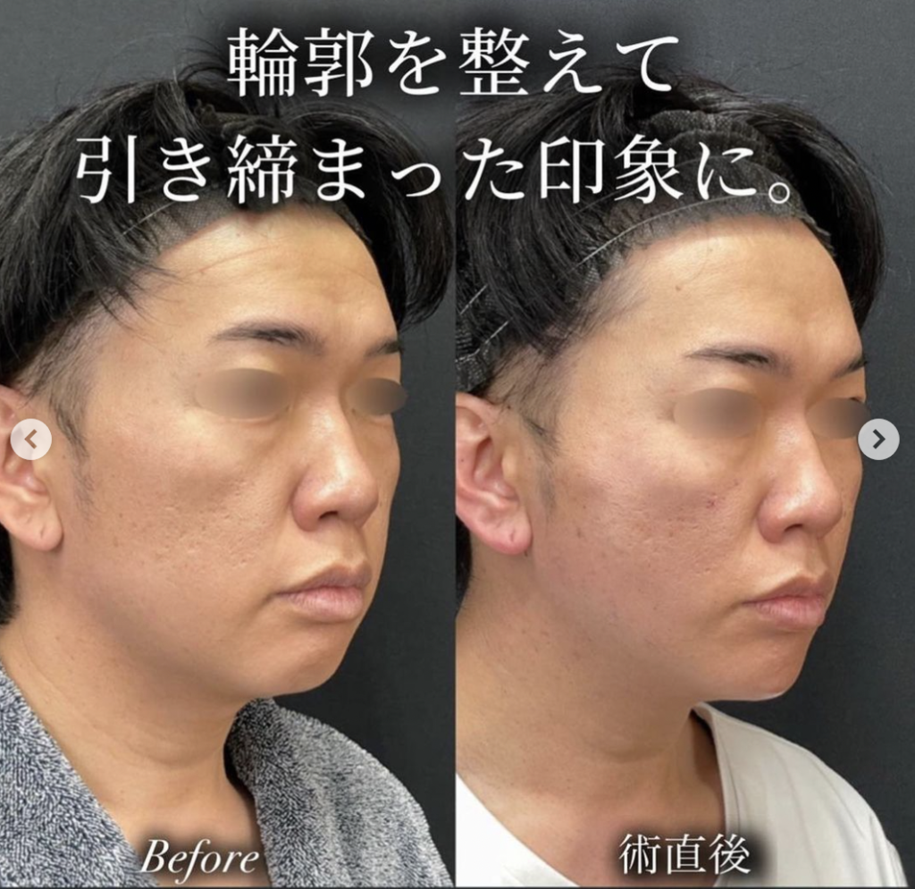 湘南美容クリニック 神戸 糸リフト