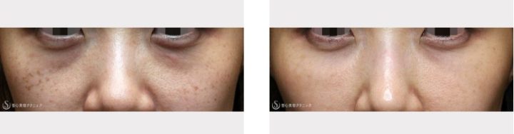 聖心美容クリニック 経結膜下脱脂法症例写真