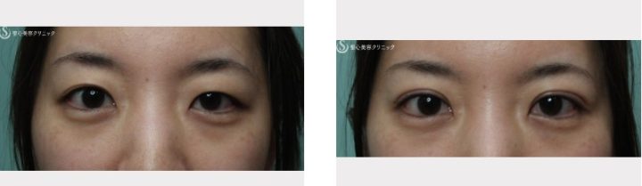 聖心美容クリニック 二重埋没法症例写真