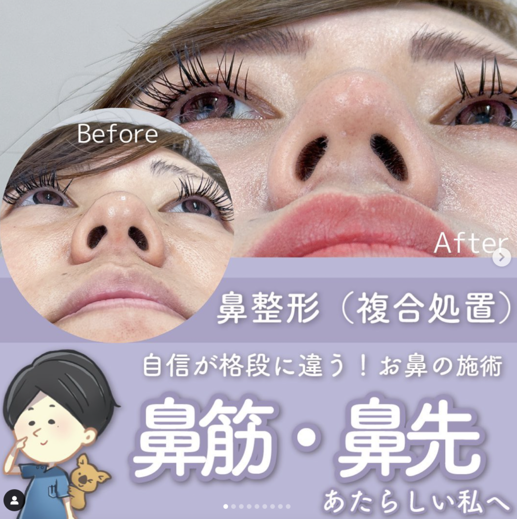 TCB東京中央美容外科 名古屋 小鼻縮小ボトックス