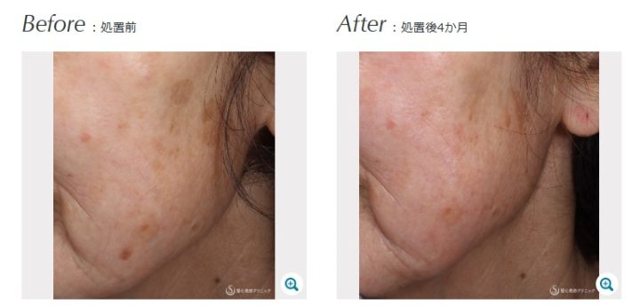 聖心美容クリニック シミ取り(ピコレーザー)症例写真