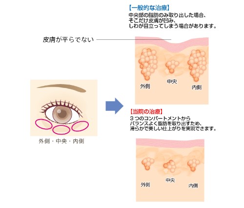 聖心美容クリニック 経結膜下脱脂法