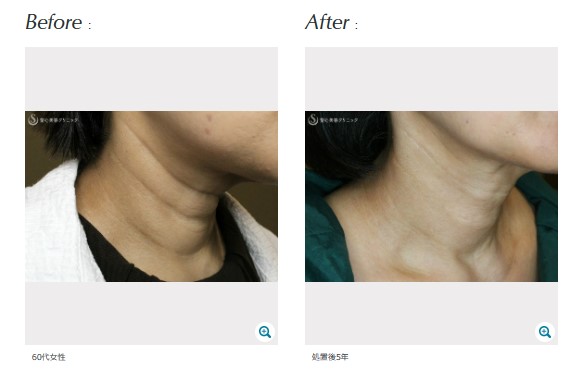 聖心美容クリニック プレミアムPRP皮膚再生療法 症例写真