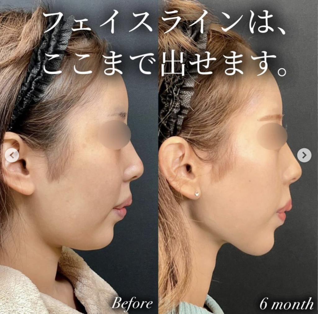 湘南美容クリニック 神戸 糸リフト