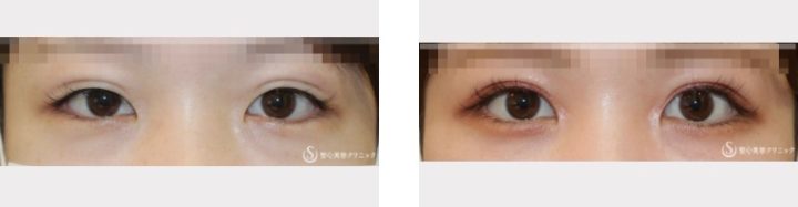 聖心美容クリニック 二重切開症例写真