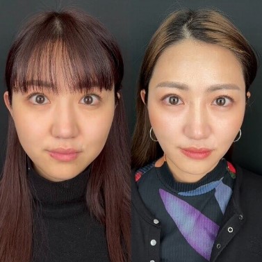 L'or Clinic Omotesando 糸リフト症例写真