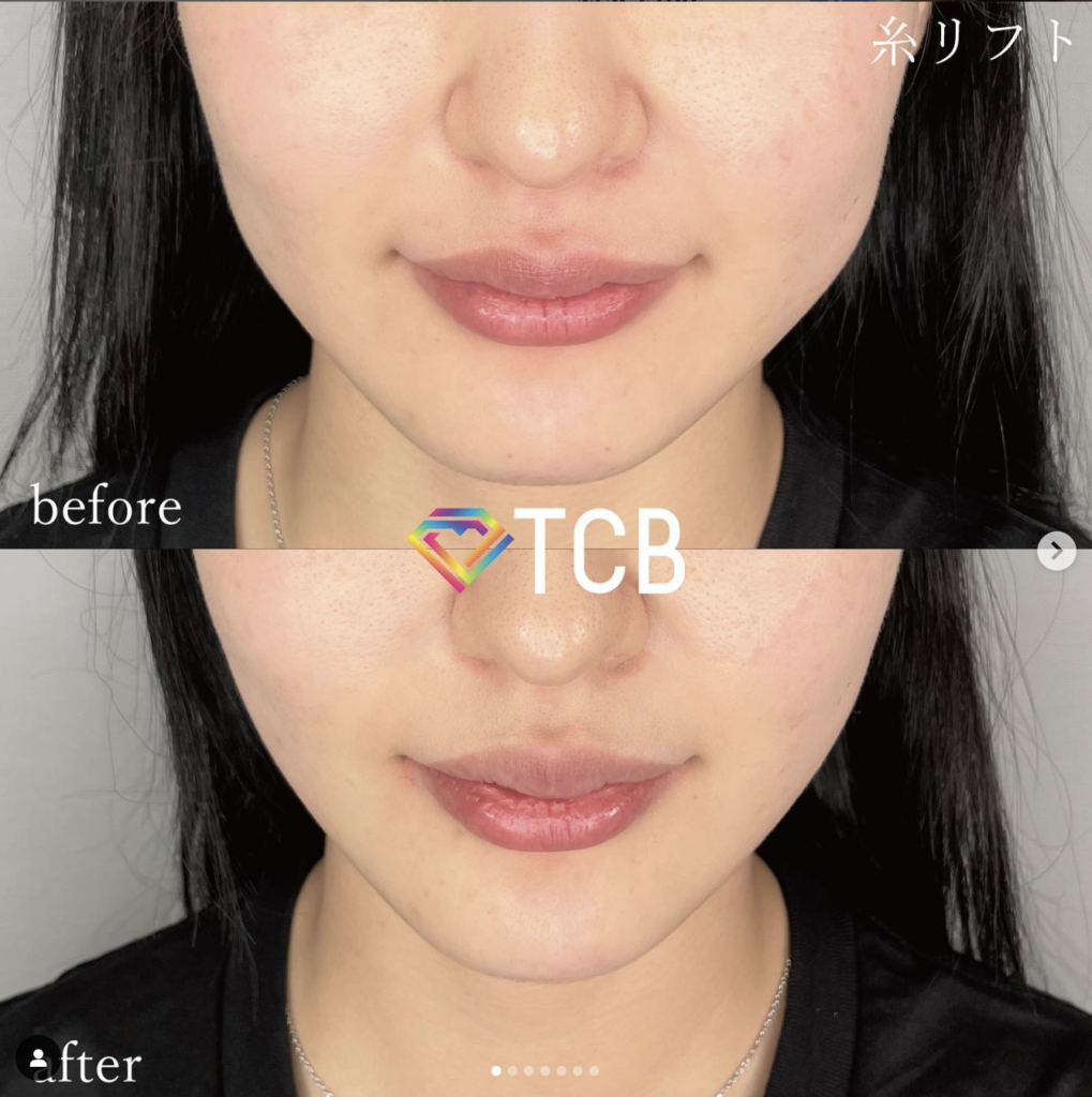 TCB東京中央美容外科 神戸 糸リフト