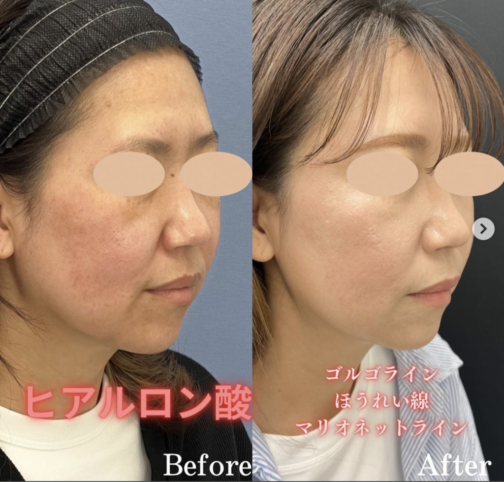 湘南美容クリニック　仙台　ヒアルロン酸