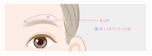 TCB東京中央美容外科 名古屋　眉上ボトックス解説
