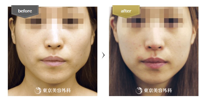 東京美容外科 名古屋 エラボトックス症例写真
