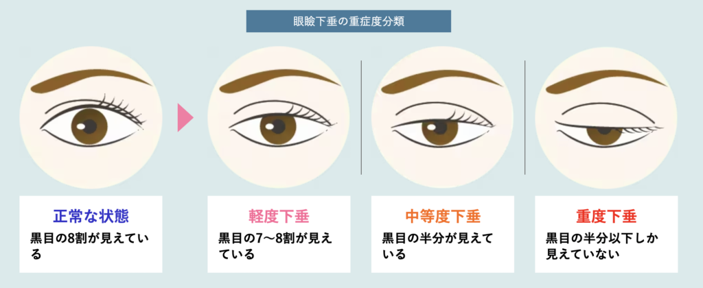 湘南美容クリニック　大阪　眼瞼下垂