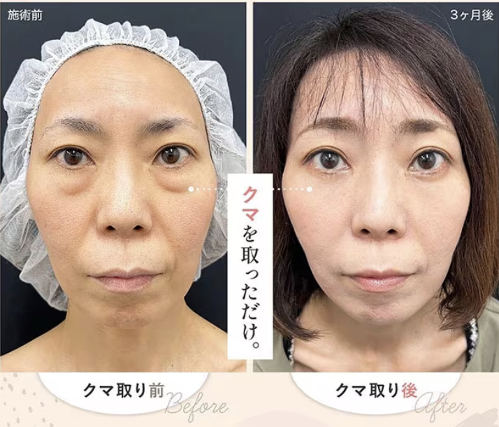 湘南美容外科 目の下の切らないクマ・たるみ(ふくらみ)取り