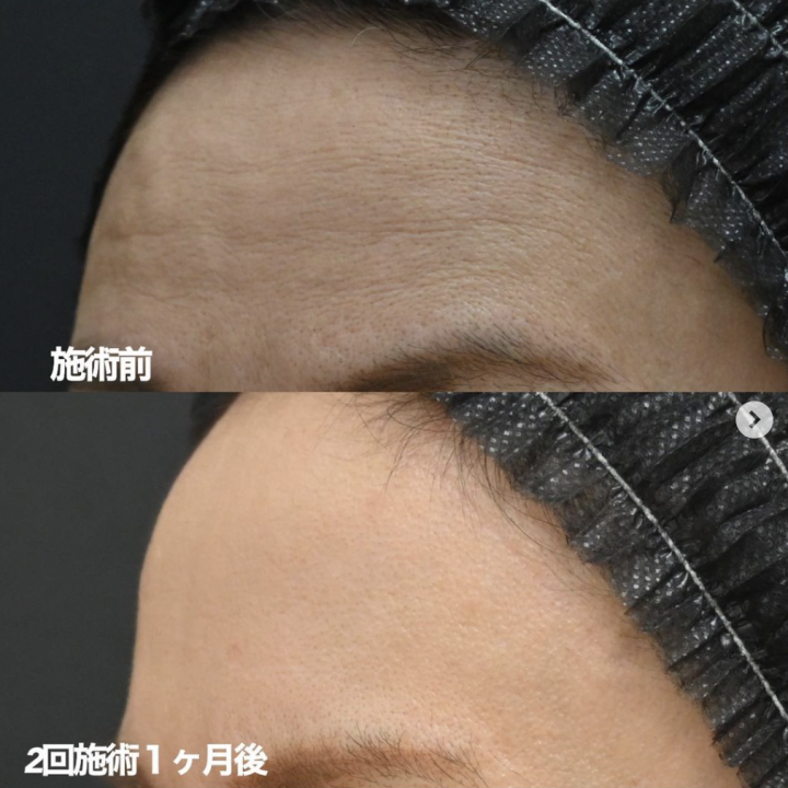 湘南美容クリニック 大阪 おでこボトックス