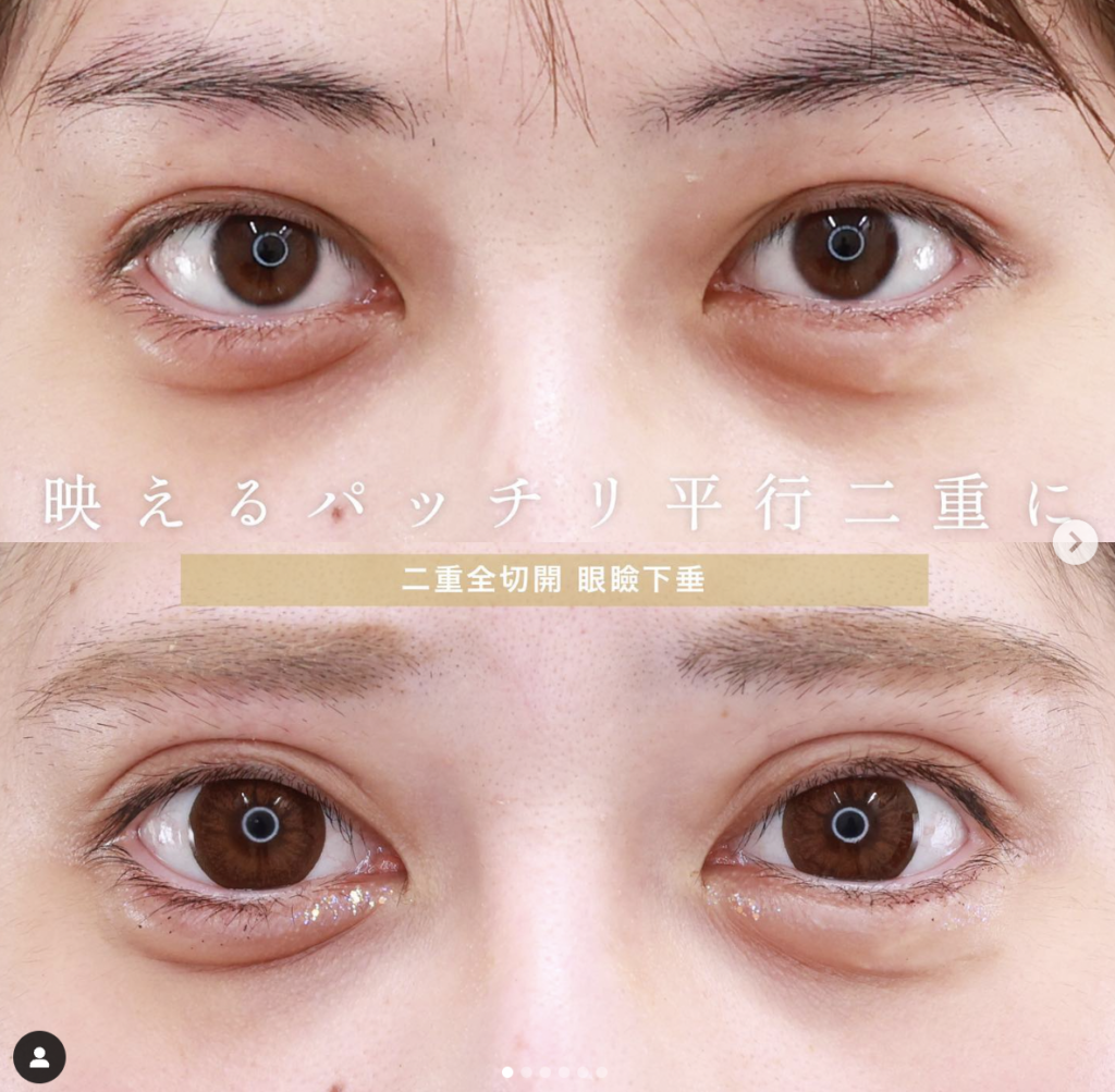 大阪TAクリニック　眼瞼下垂