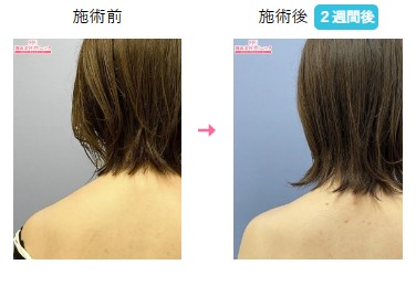 湘南美容クリニック 銀座 肩ボトックス症例写真