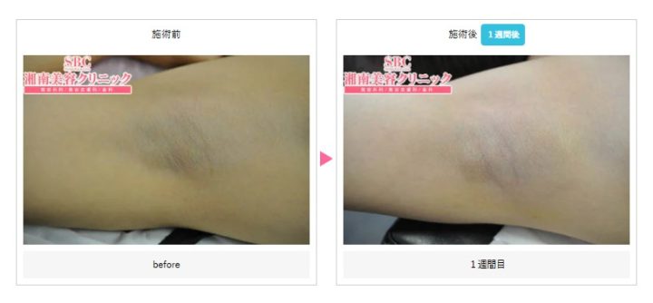 湘南美容クリニック 名古屋 脇汗ボトックス注射症例写真