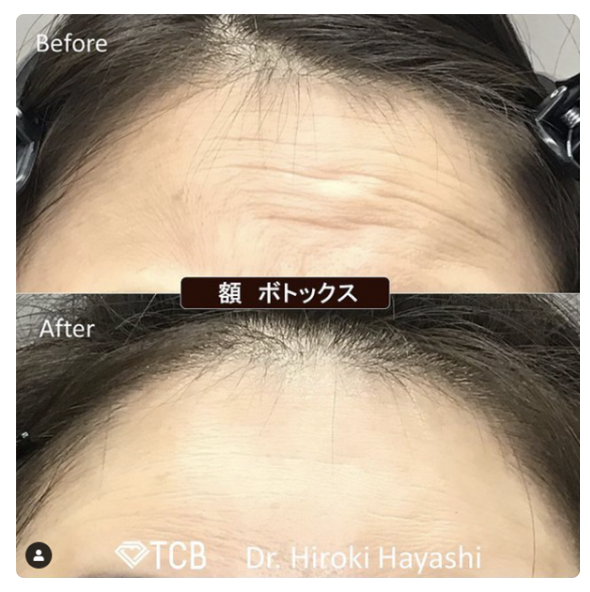TCB東京中央美容外科 大阪 おでこボトックス