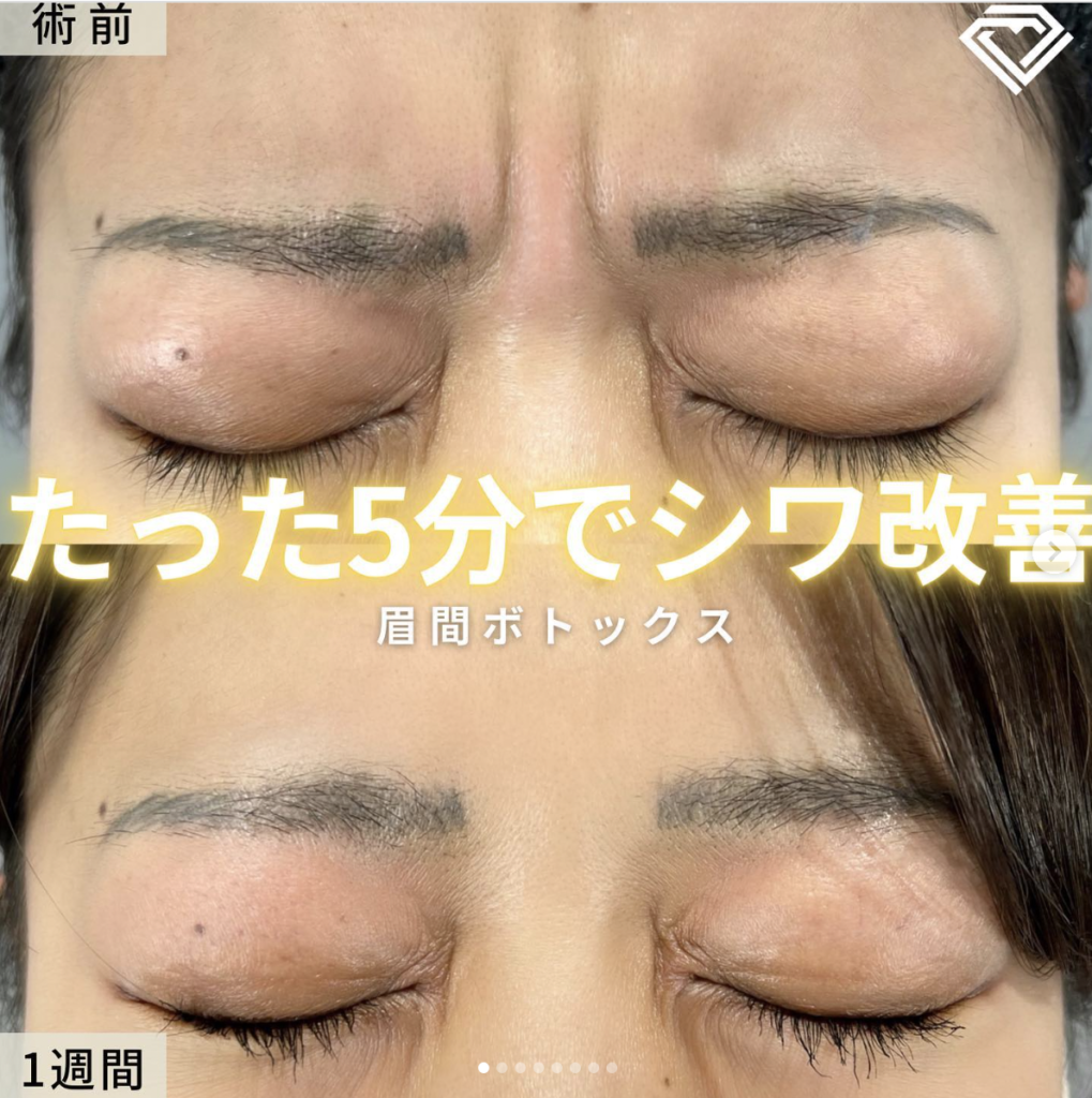 TCB東京中央美容外科 大阪 眉間ボトックス