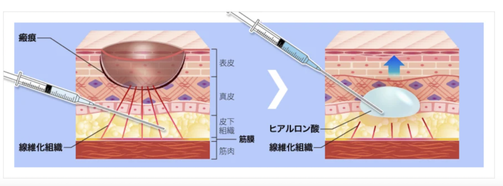 TCB東京中央美容外科 名古屋 メンズ ニキビ跡治療