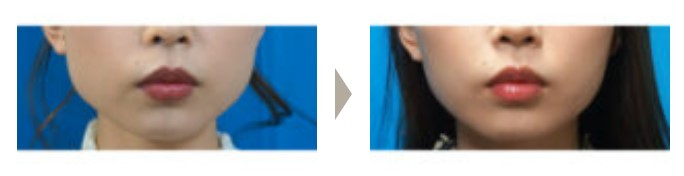 ガーデンクリニック 名古屋ボトックス注射 症例写真
