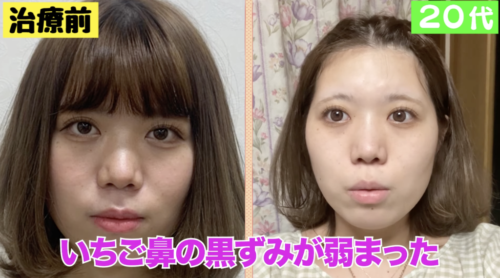 湘南美容クリニック ダーマペン 鼻のみ
