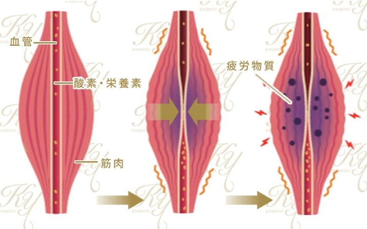 共立美容外科　肩ボトックス