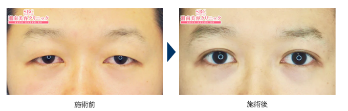 湘南美容クリニック 二重術症例写真 メンズ 札幌