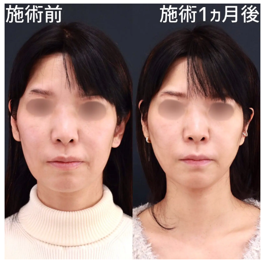 TAクリニック ボトックス 症例写真
