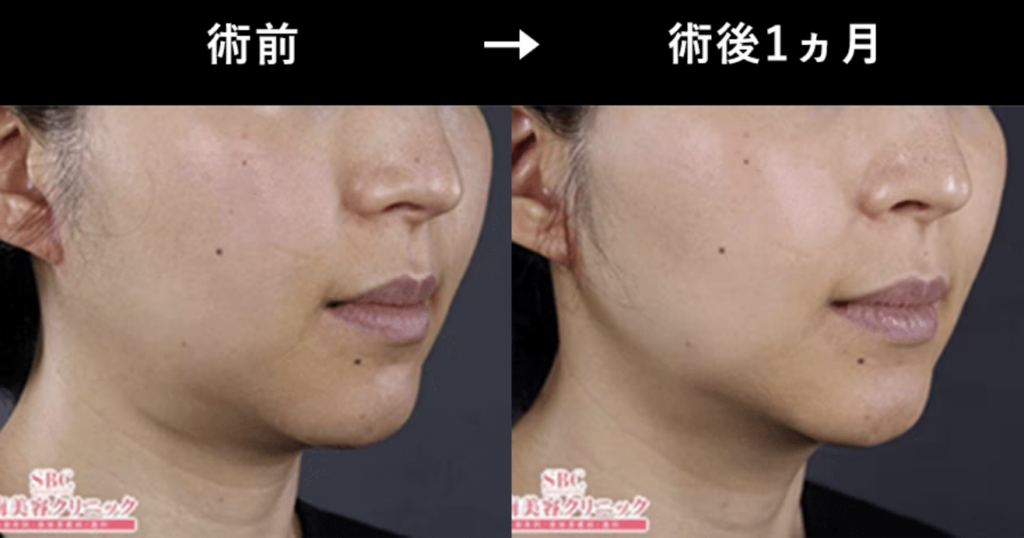 湘南美容クリニック　千葉　ハイフ