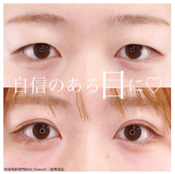 TAクリニック 二重埋没 札幌 症例写真
