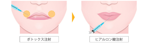 ガーデンクリニック 口角ボトックス　千葉施術箇所説明