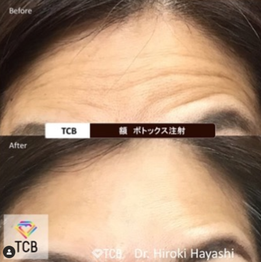 TCB東京中央美容外科 ボトックス