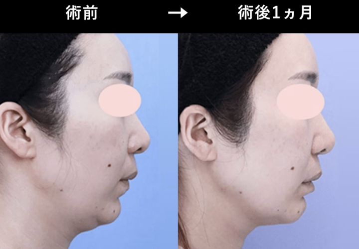 湘南美容クリニック　千葉　ハイフ